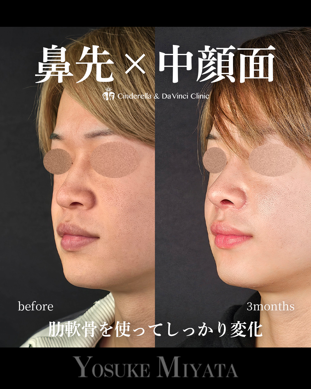 肋軟骨の鼻フルの画像