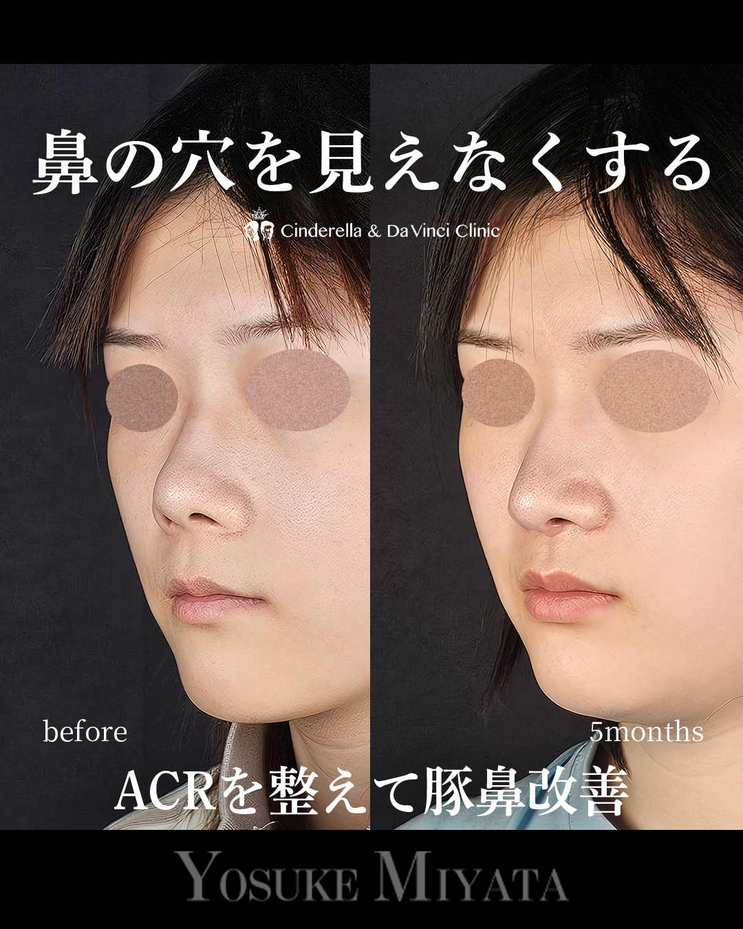 鼻の穴を見えなくするの画像