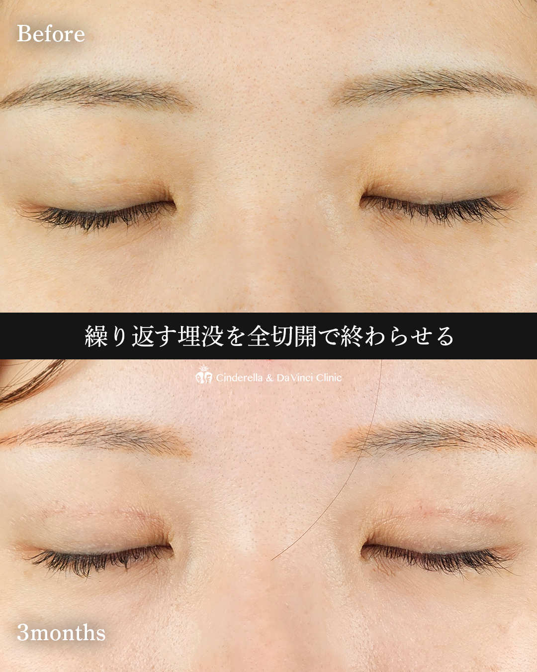 華やかな二重にの画像