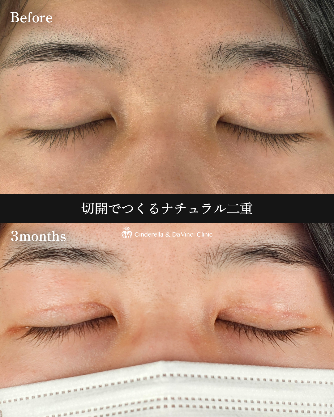 男性の二重切開の画像