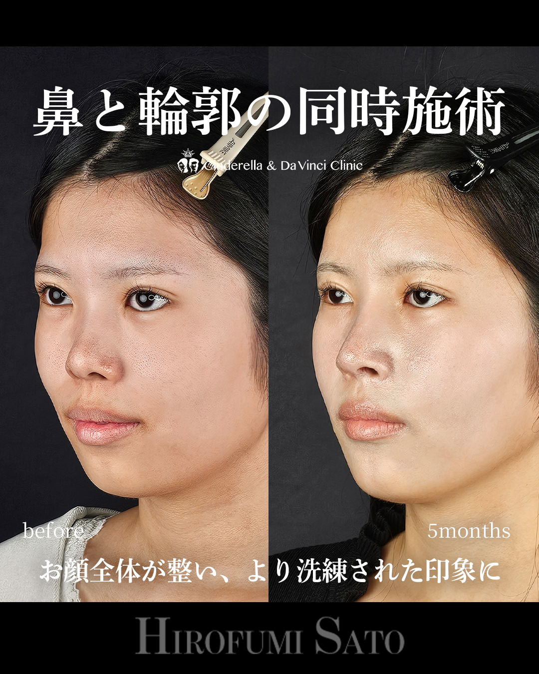 鼻+輪郭の同時施術の画像