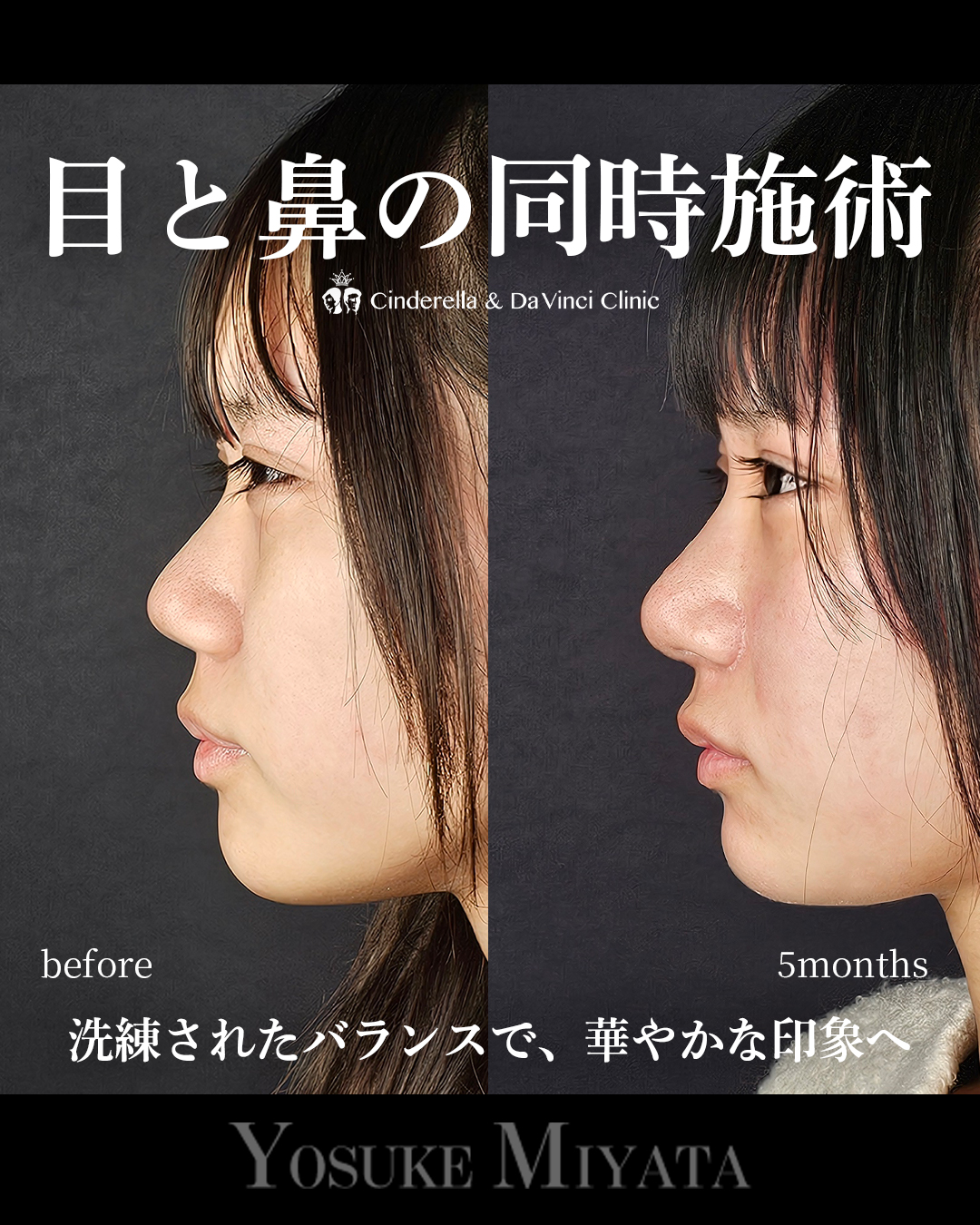 目と鼻の同時施術の画像