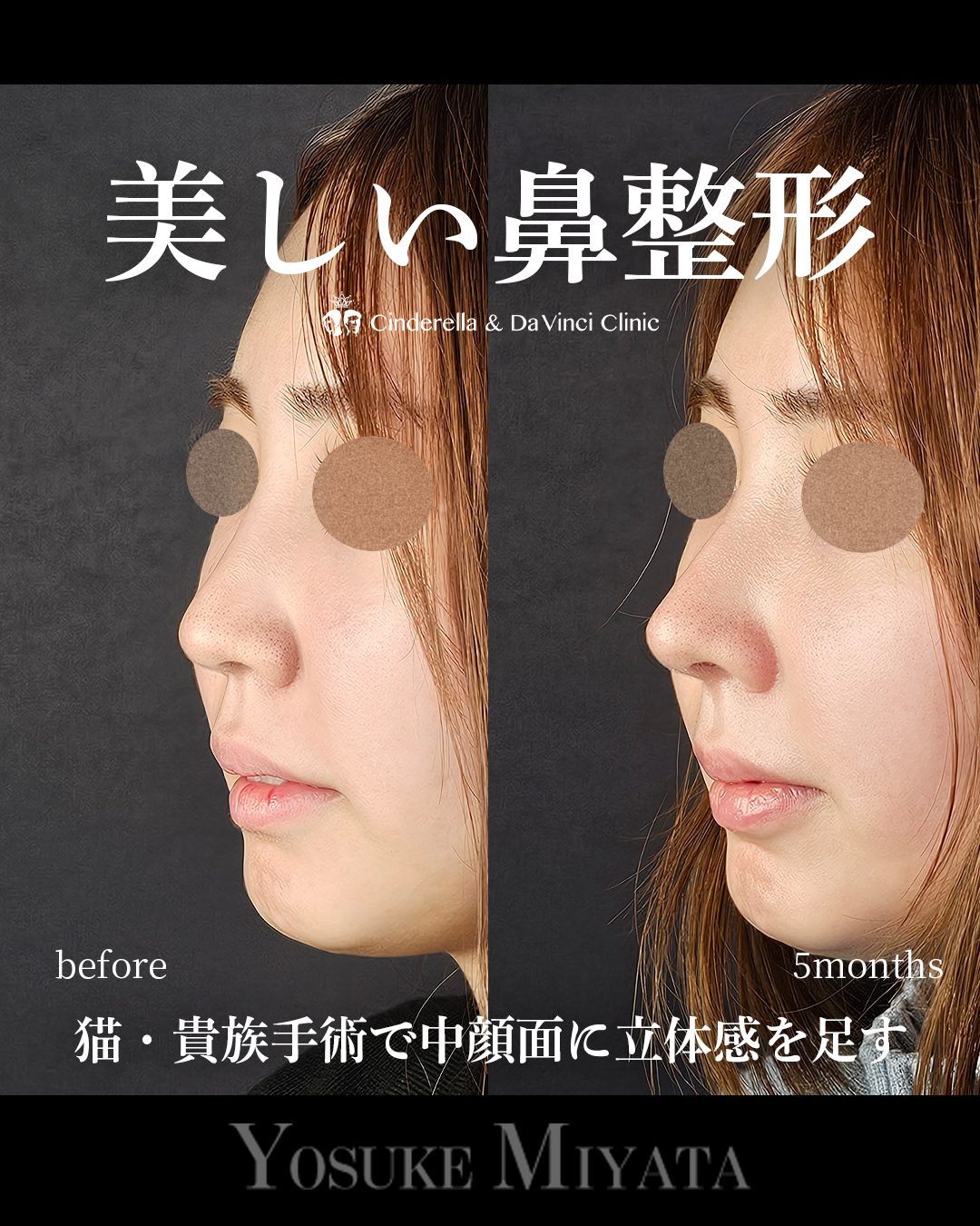 美しい鼻整形の画像