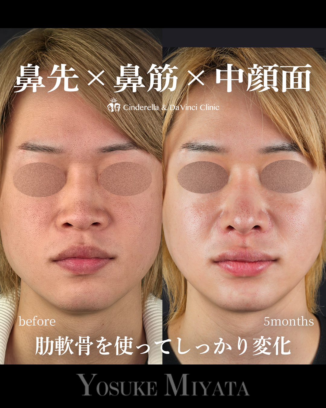 肋軟骨の鼻フルの画像