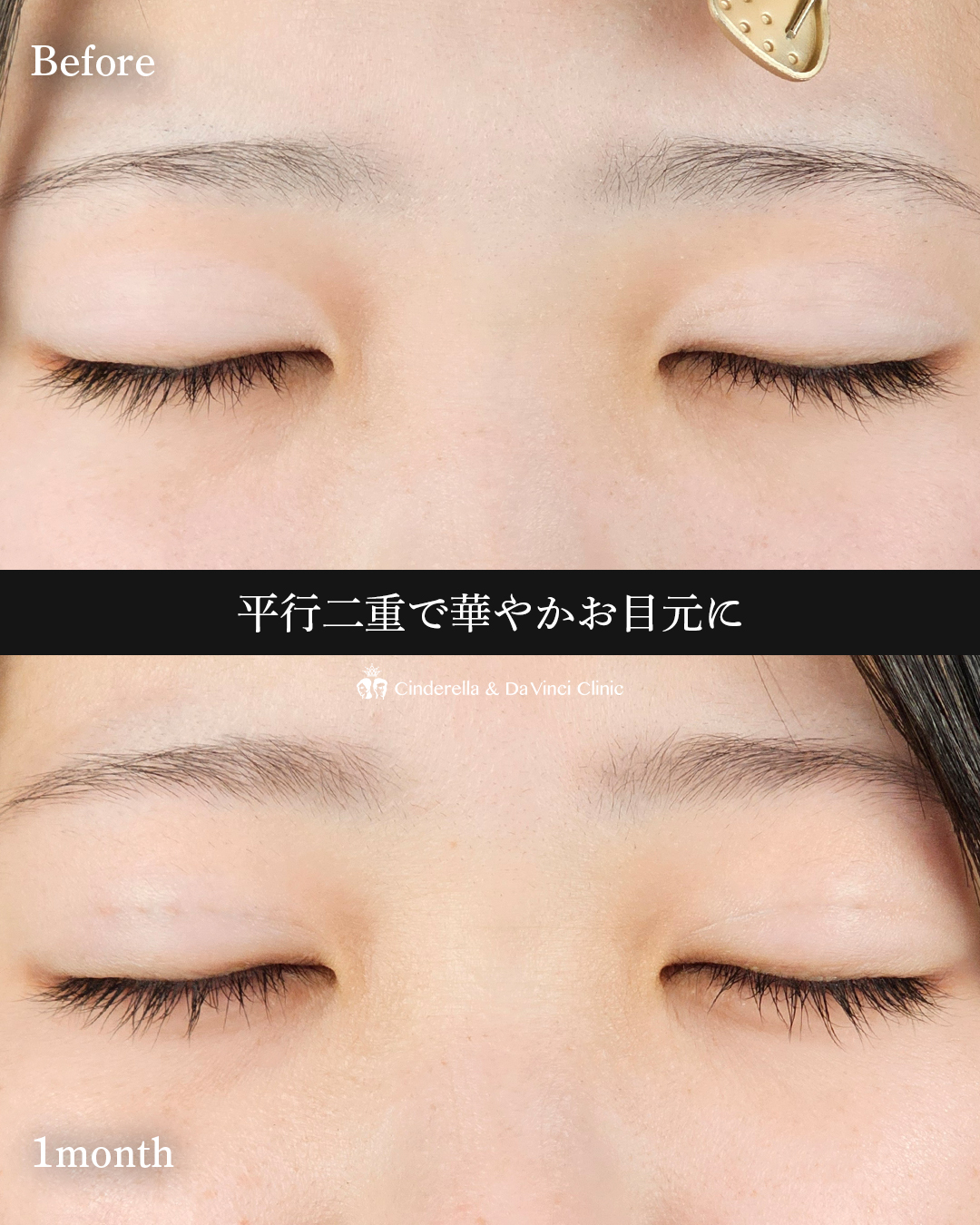 平行二重で華やかにの画像