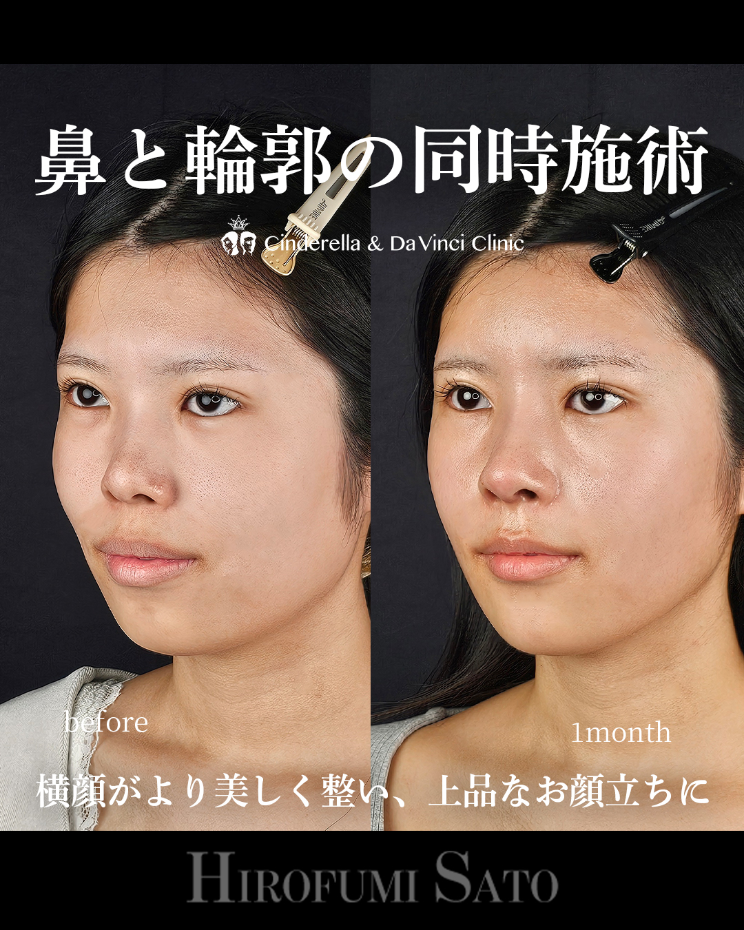 鼻+輪郭の同時施術の画像