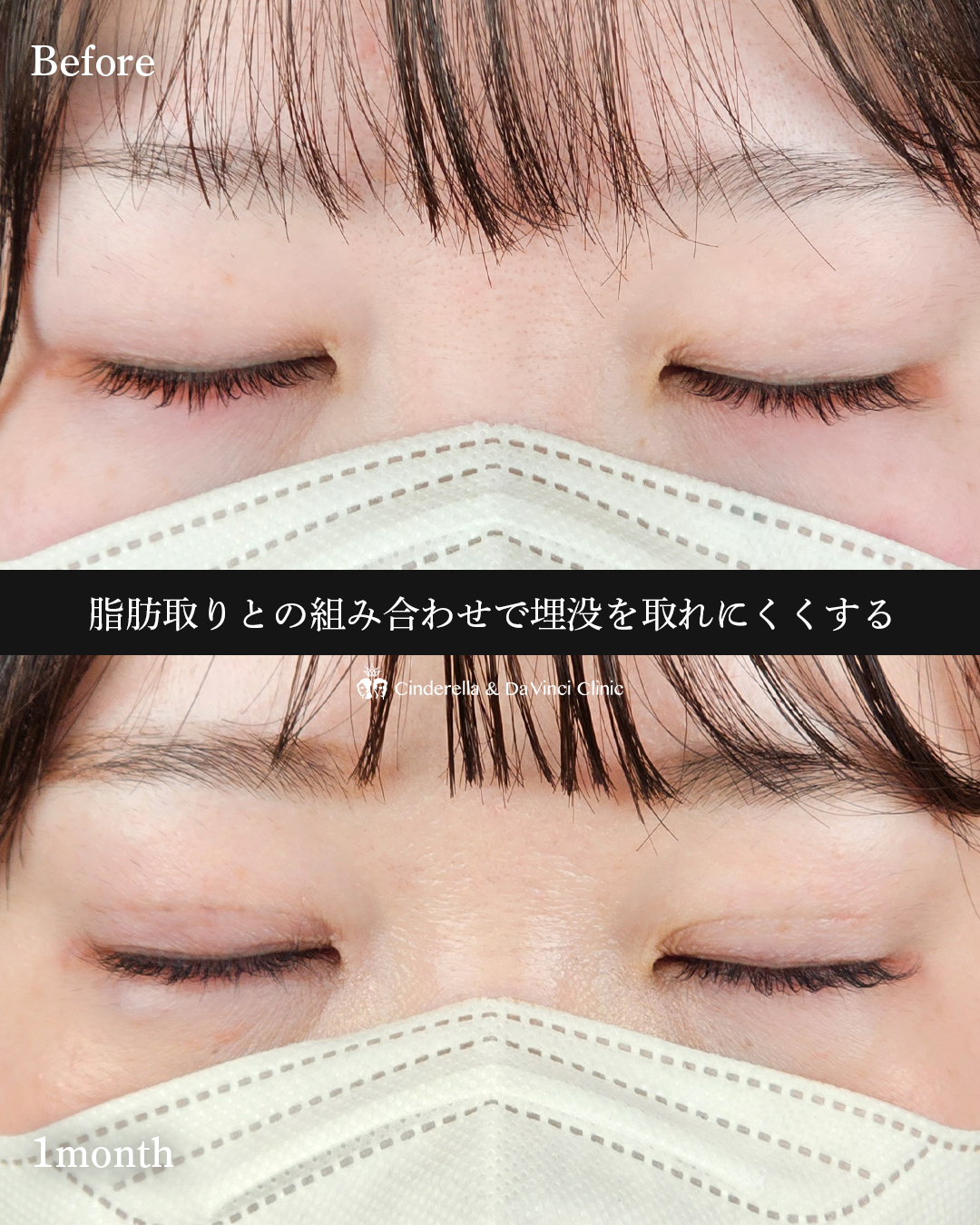 埋没×脂肪取りの画像