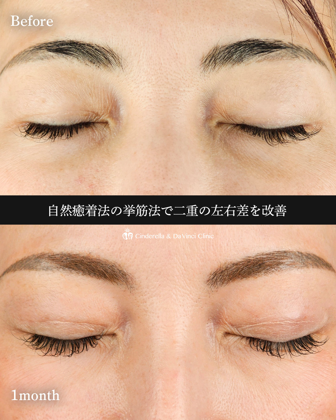 左右差改善の画像