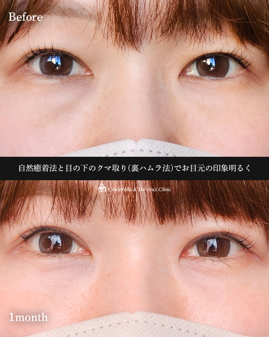 埋没×クマ取りの画像