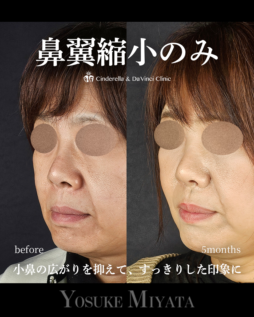 鼻翼縮小のみの画像