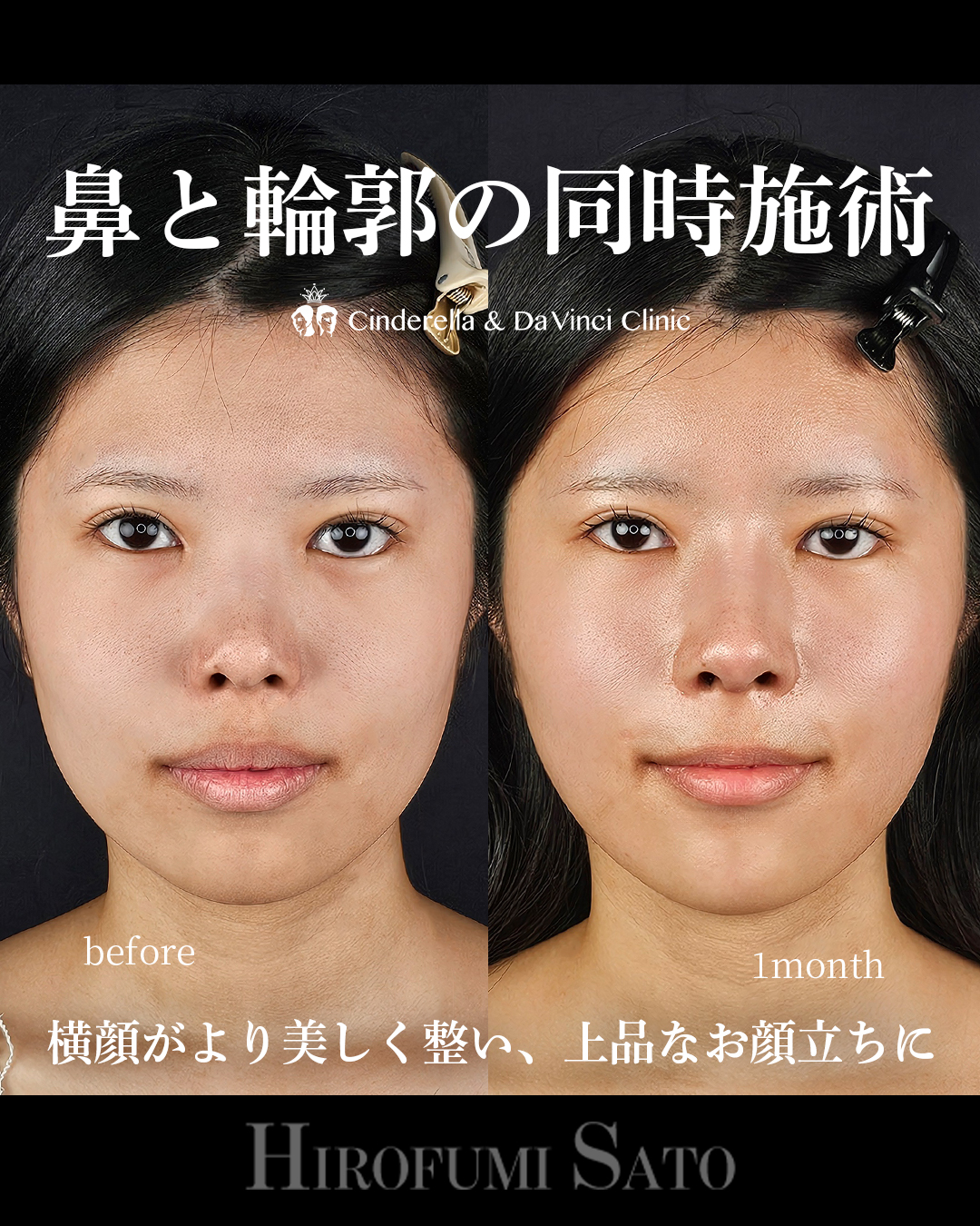 鼻+輪郭の同時施術の画像