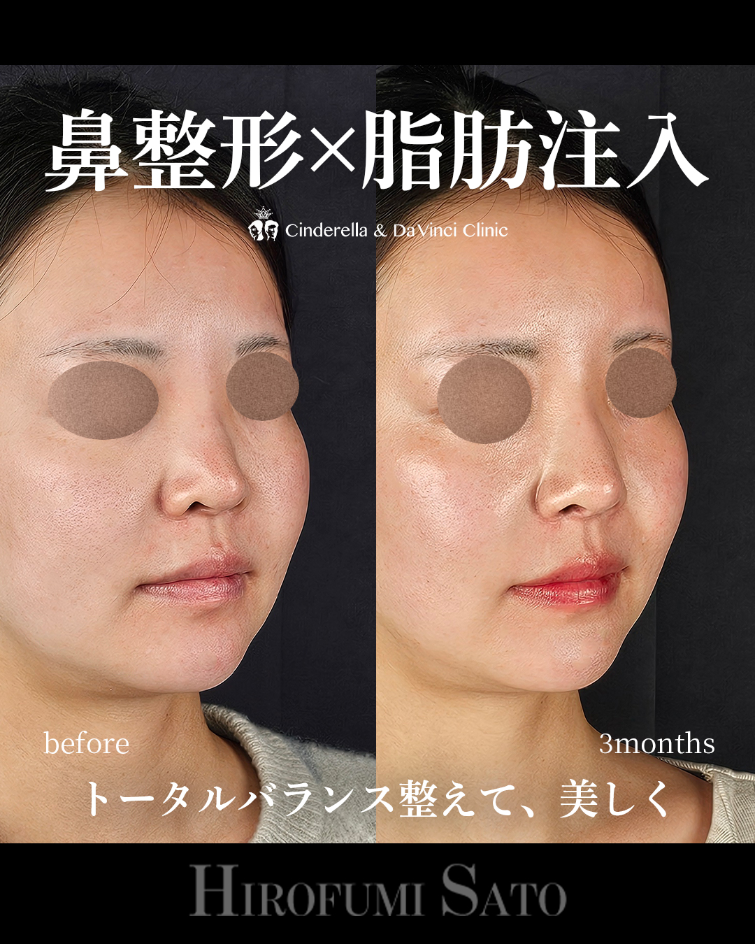 鼻整形と脂肪注入同時の画像