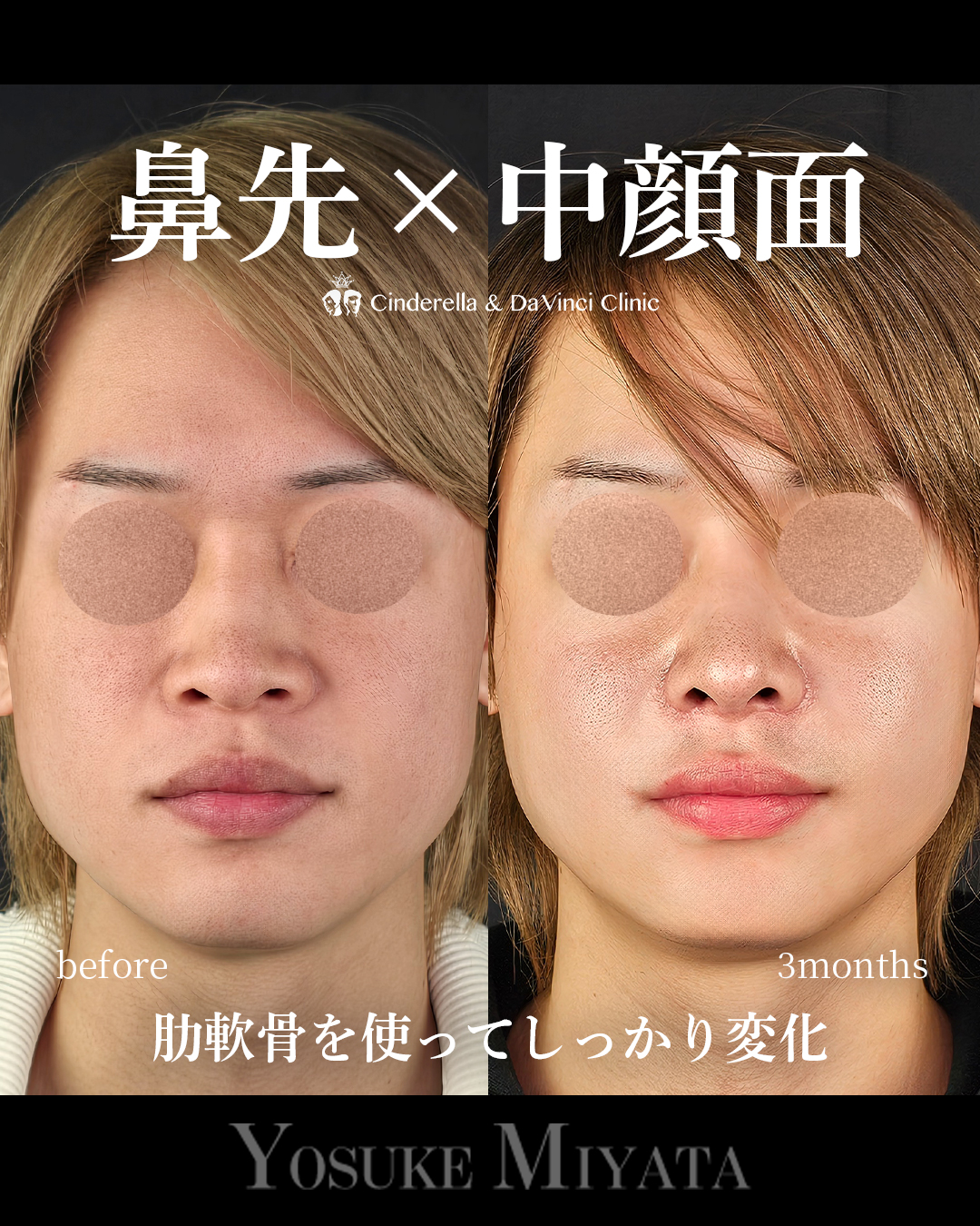 肋軟骨の鼻フルの画像