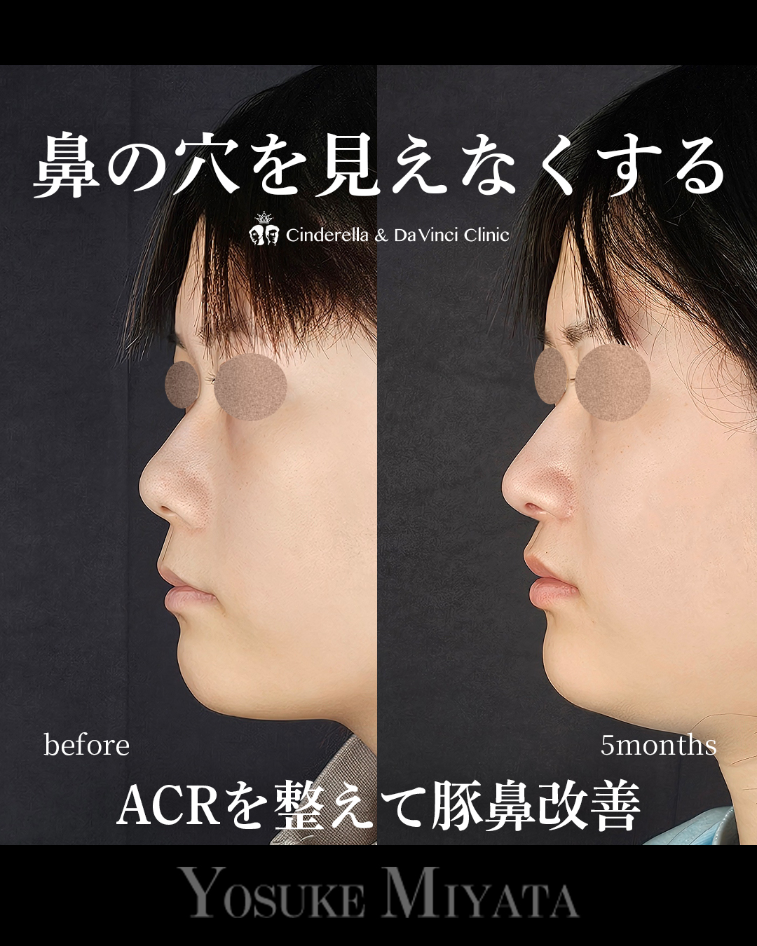 鼻の穴を見えなくするの画像