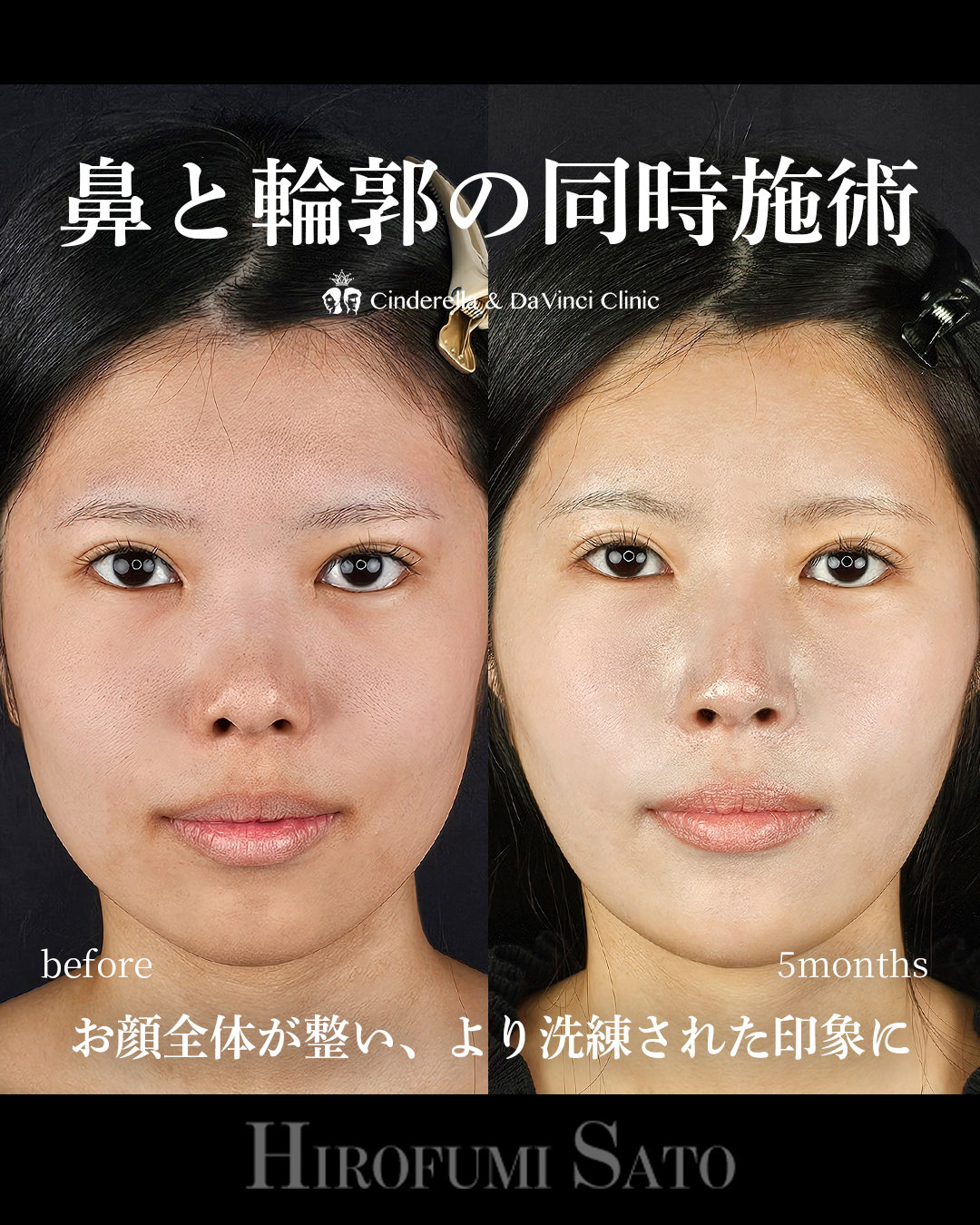鼻+輪郭の同時施術の画像
