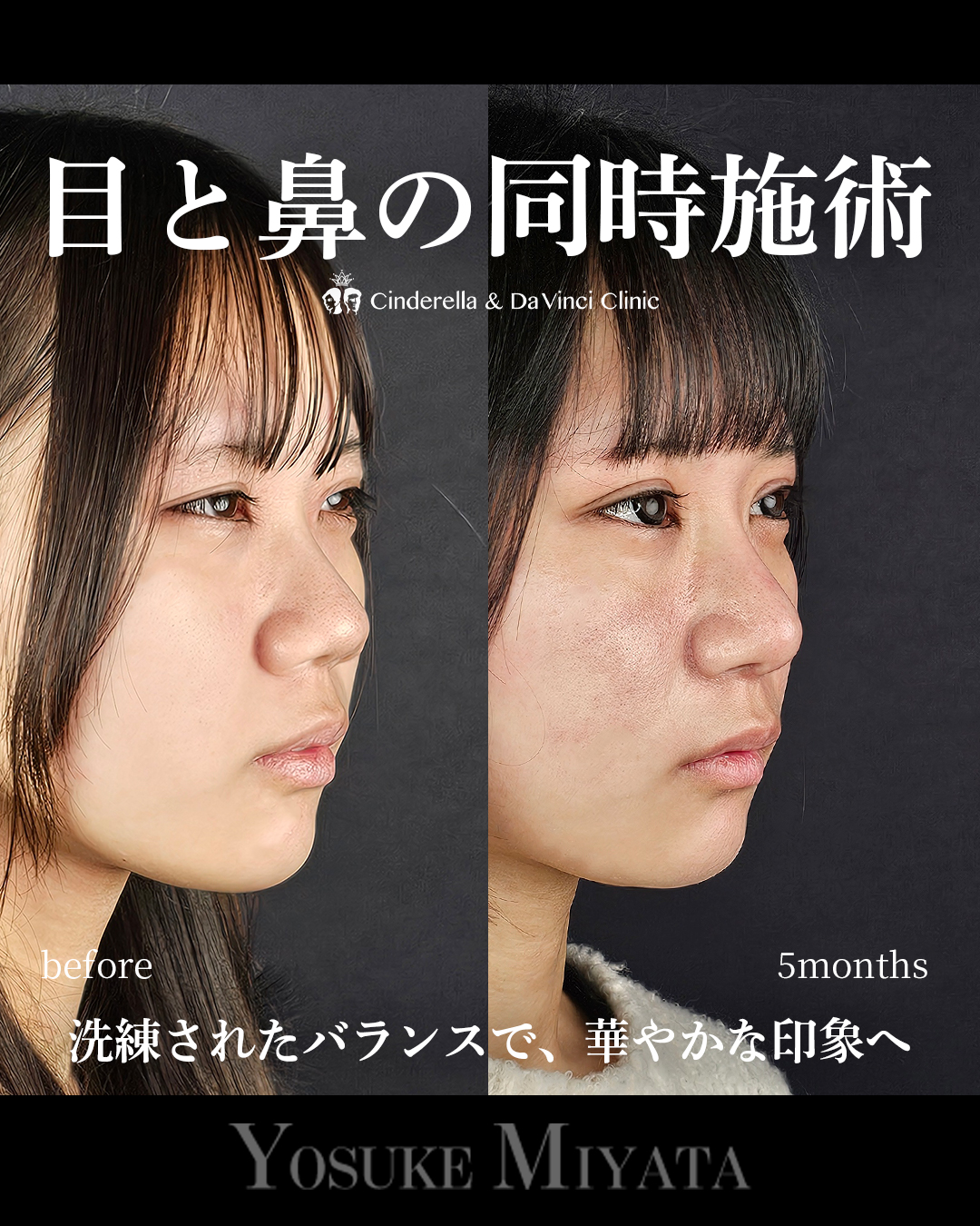 目と鼻の同時施術の画像