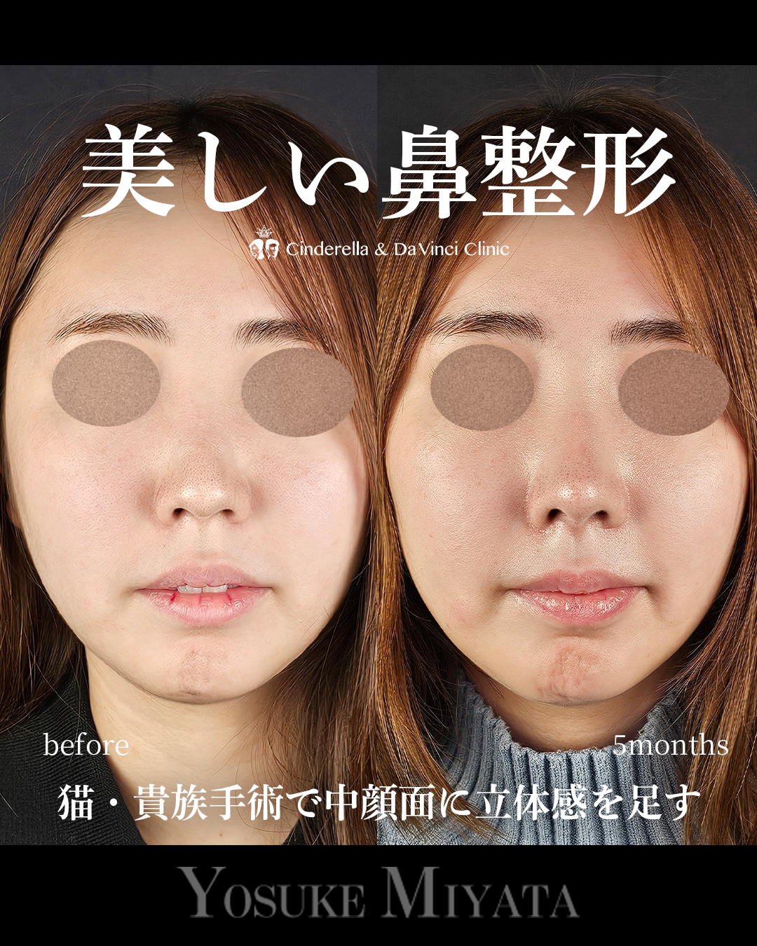 美しい鼻整形の画像