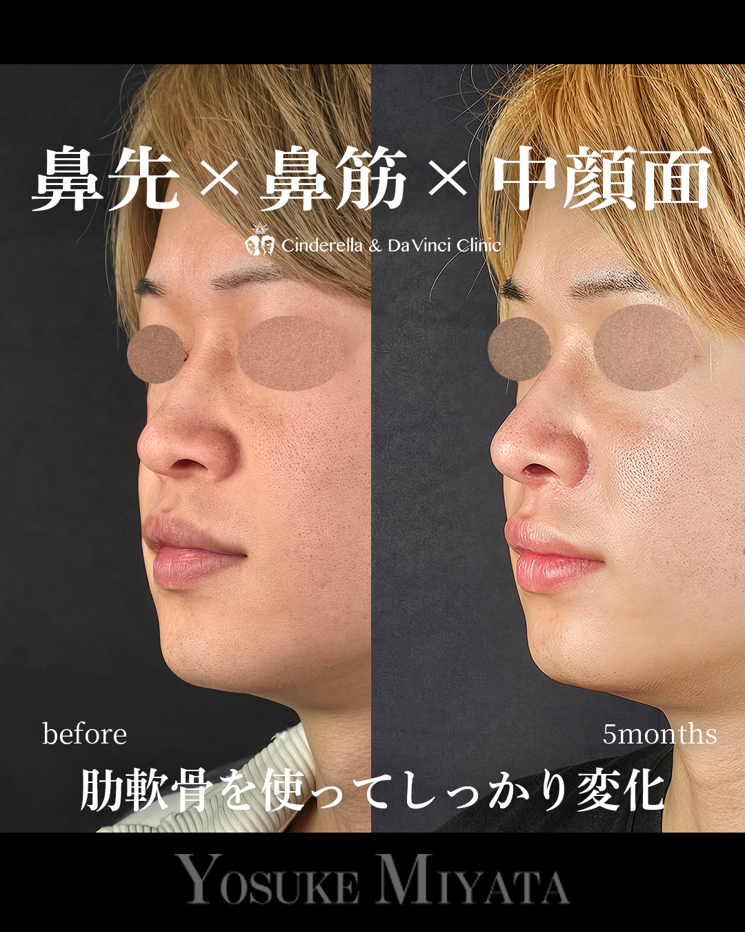 肋軟骨の鼻フルの画像