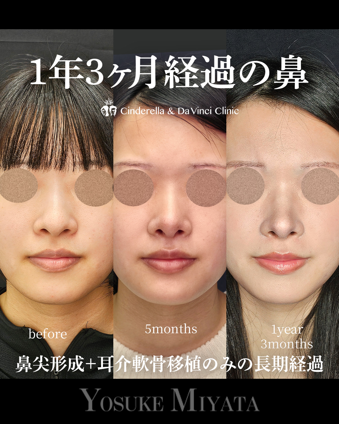 1年3ヶ月経過の鼻の画像