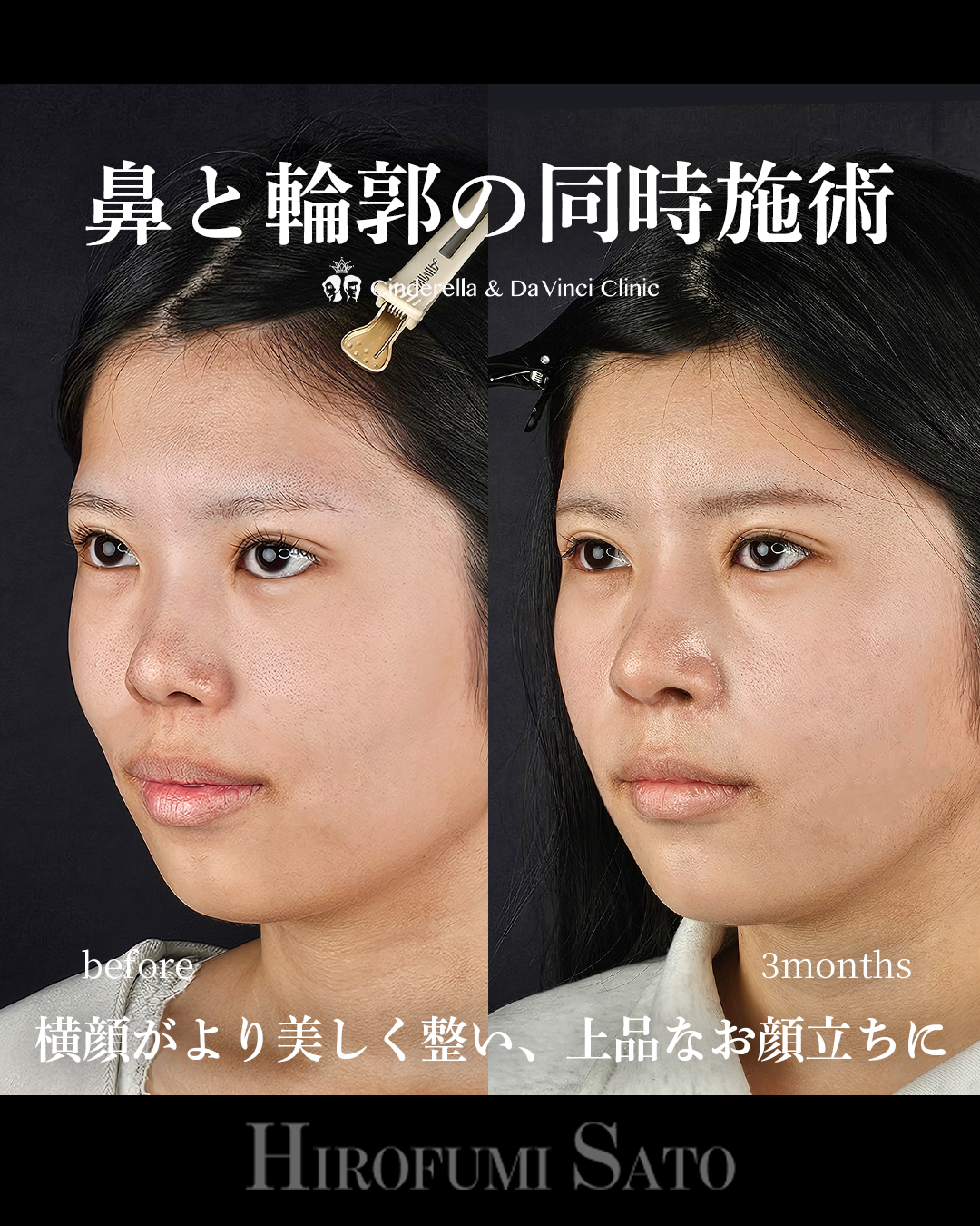 鼻+輪郭の同時施術の画像