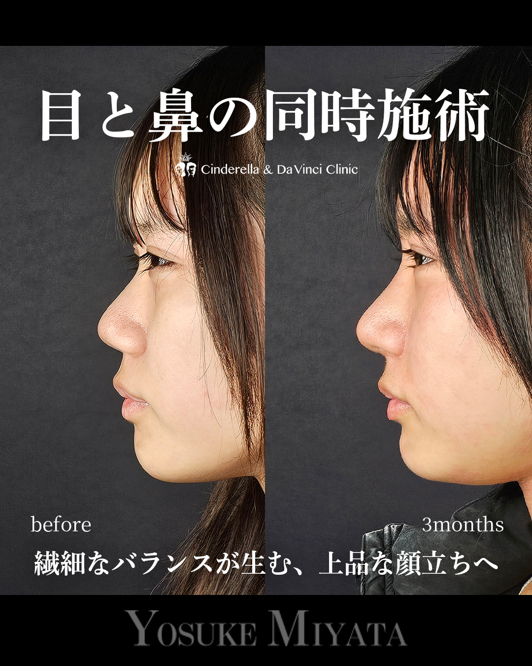 目と鼻の同時施術の画像