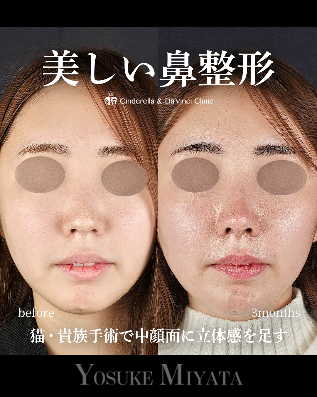 美しい鼻整形の画像