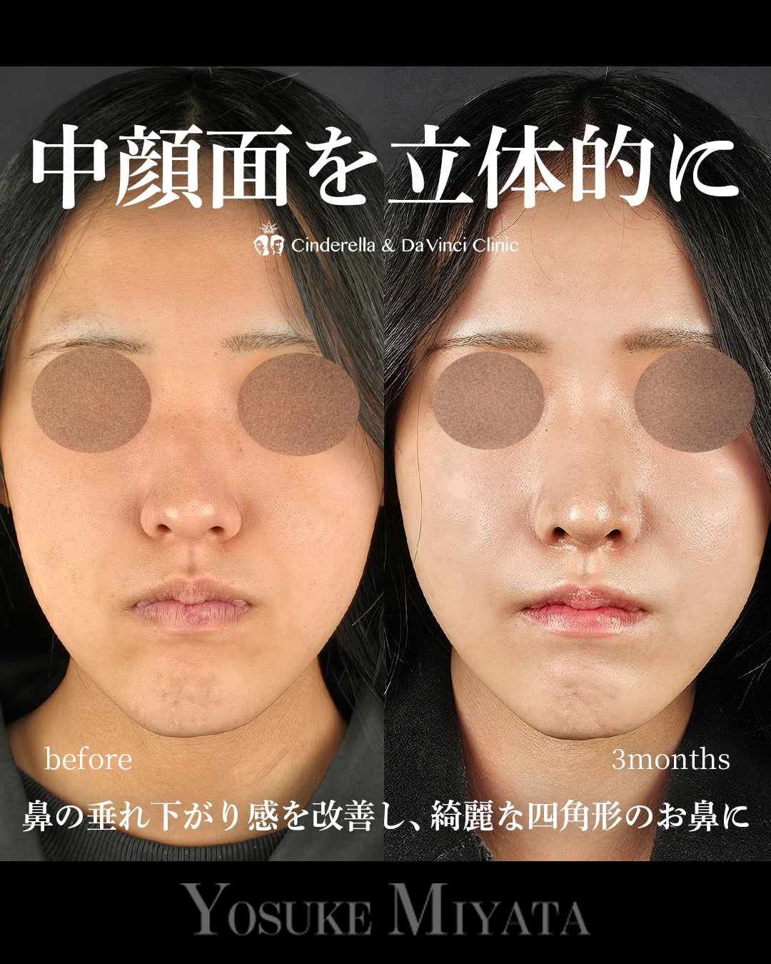 中顔面を立体的にの画像