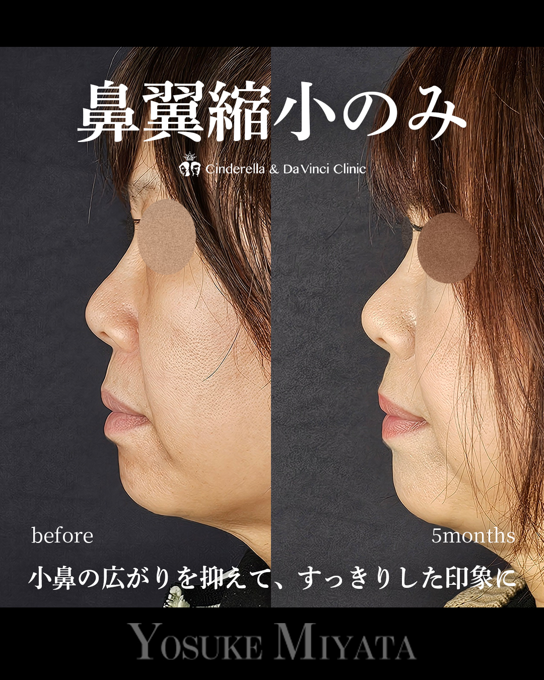 鼻翼縮小のみの画像