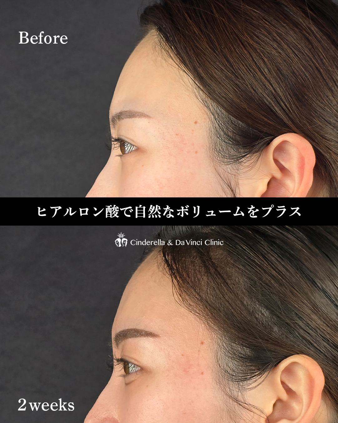 額ヒアルロン酸の画像