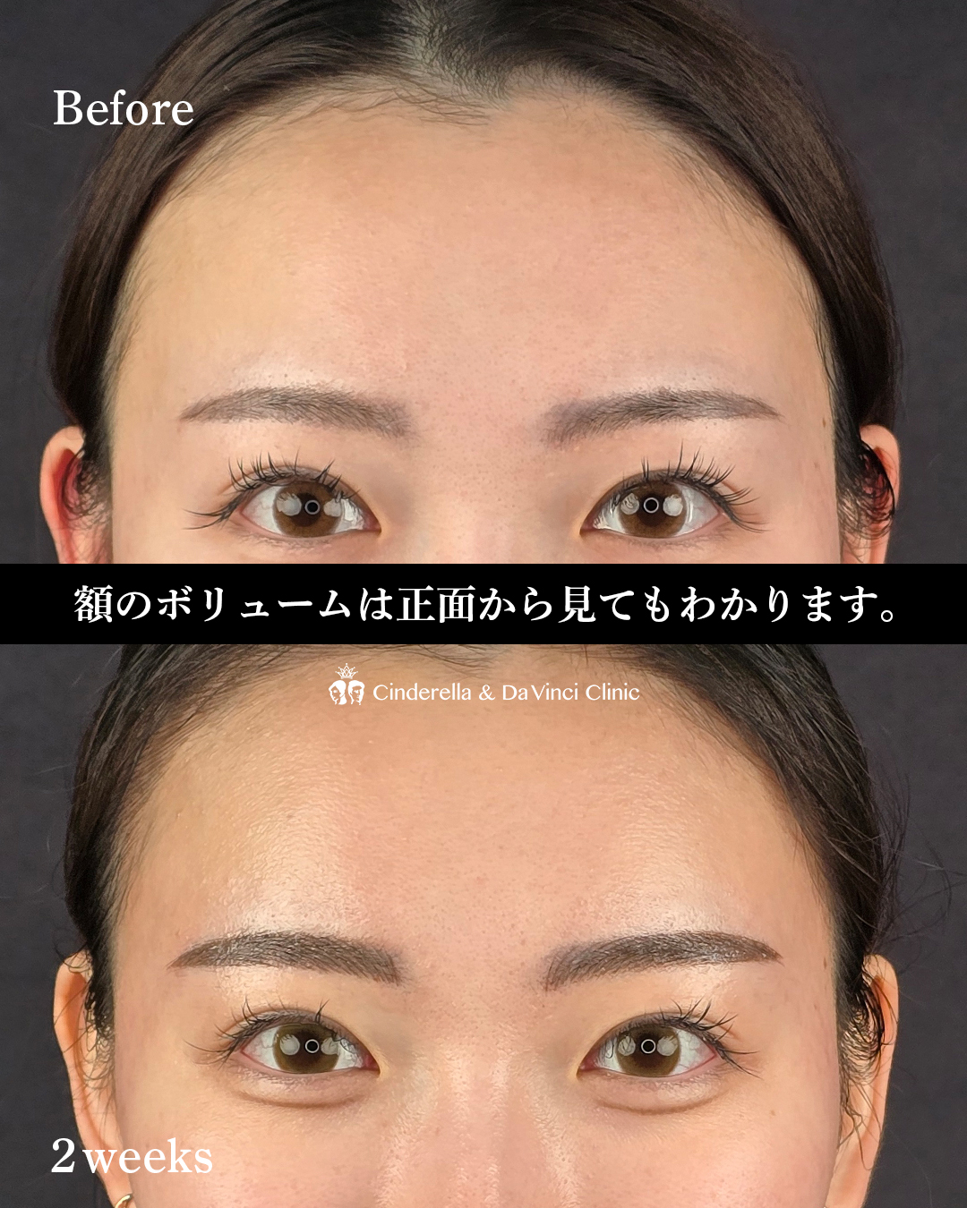 額ヒアルロン酸の画像