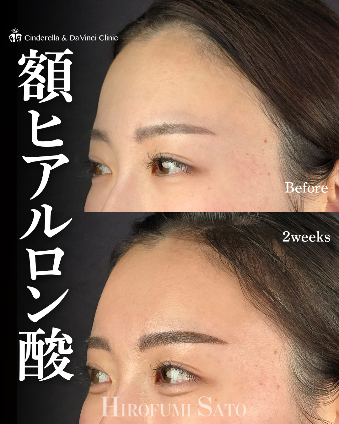 額ヒアルロン酸