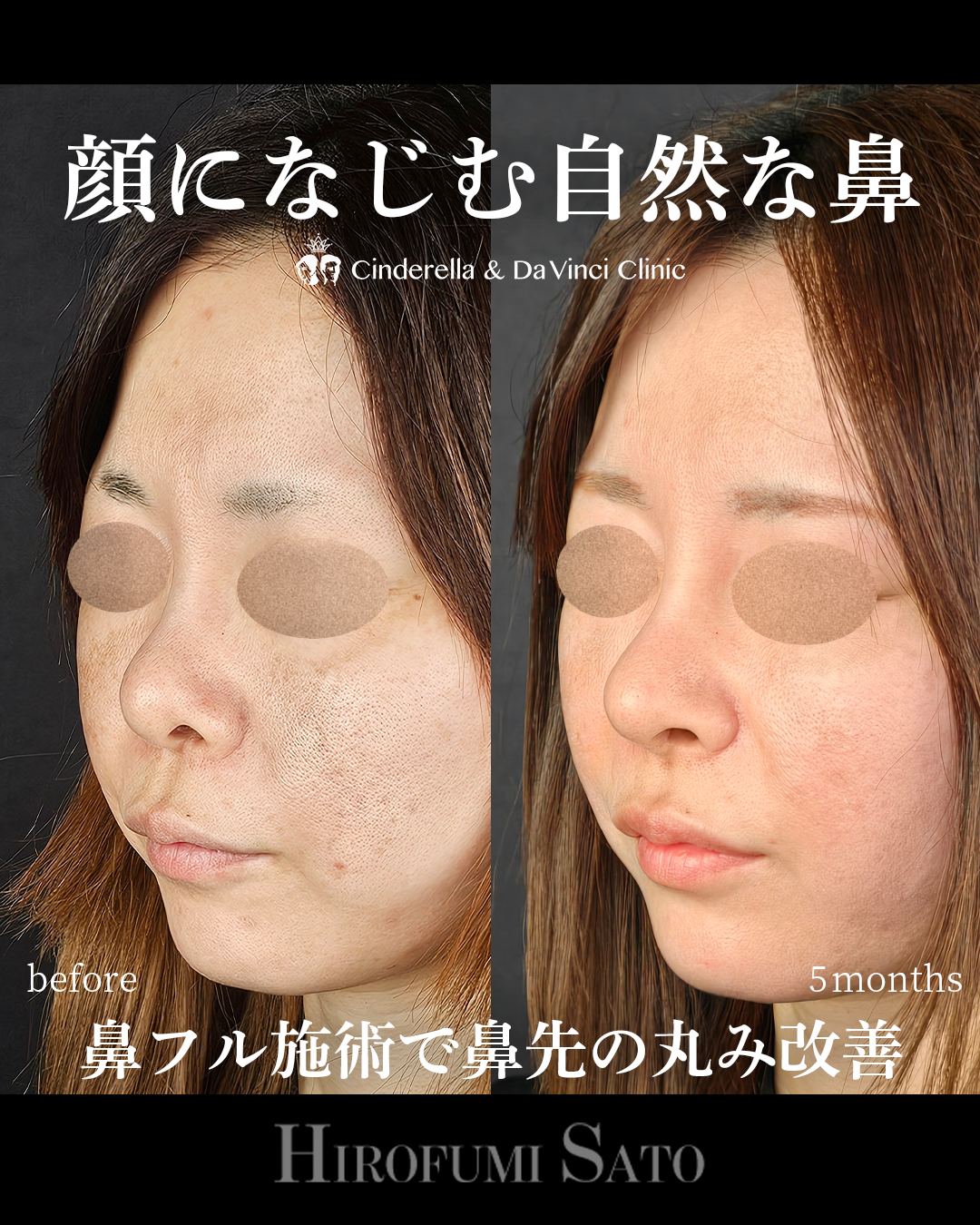 鼻先スッキリの画像