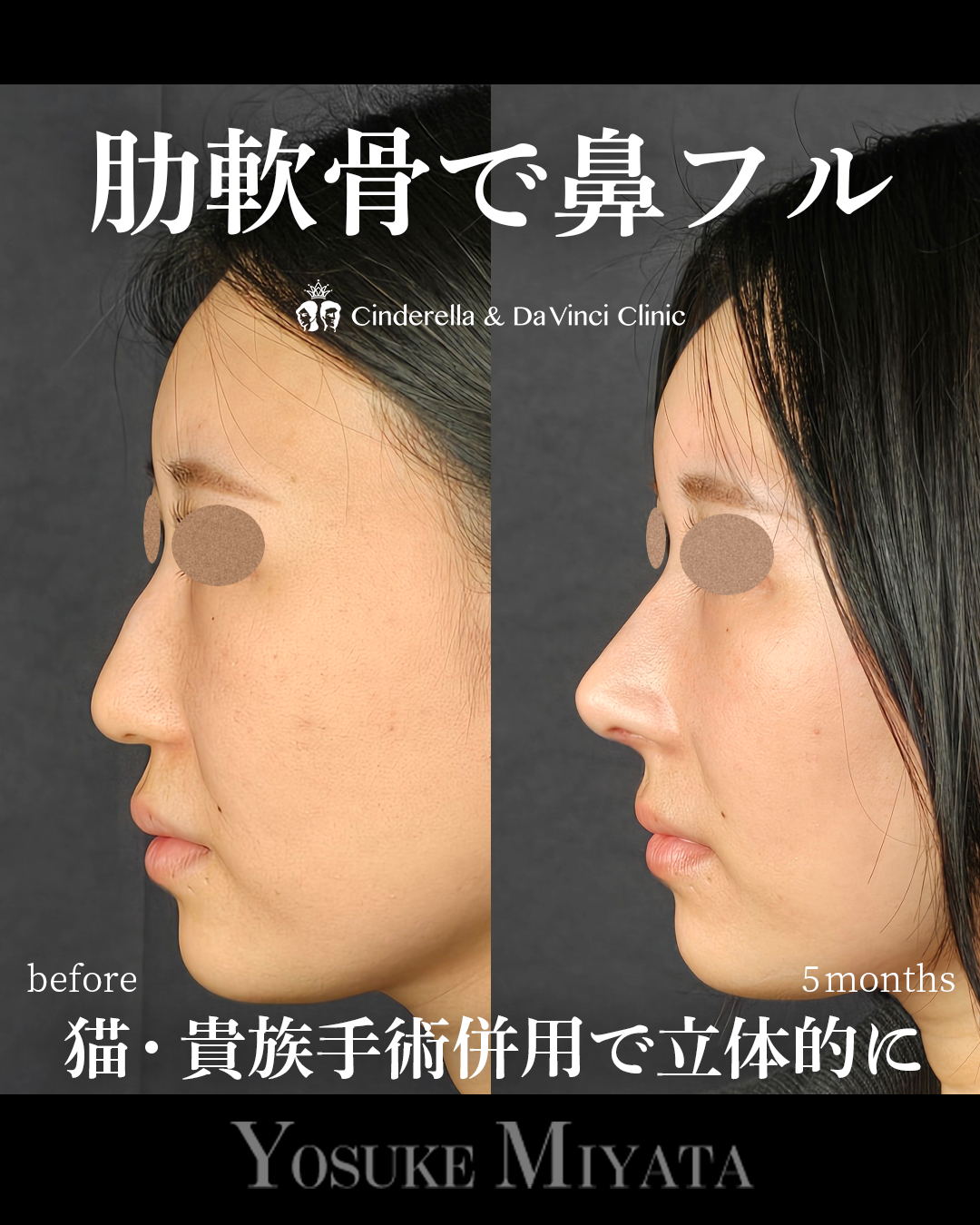 肋軟骨を使った鼻フルの画像