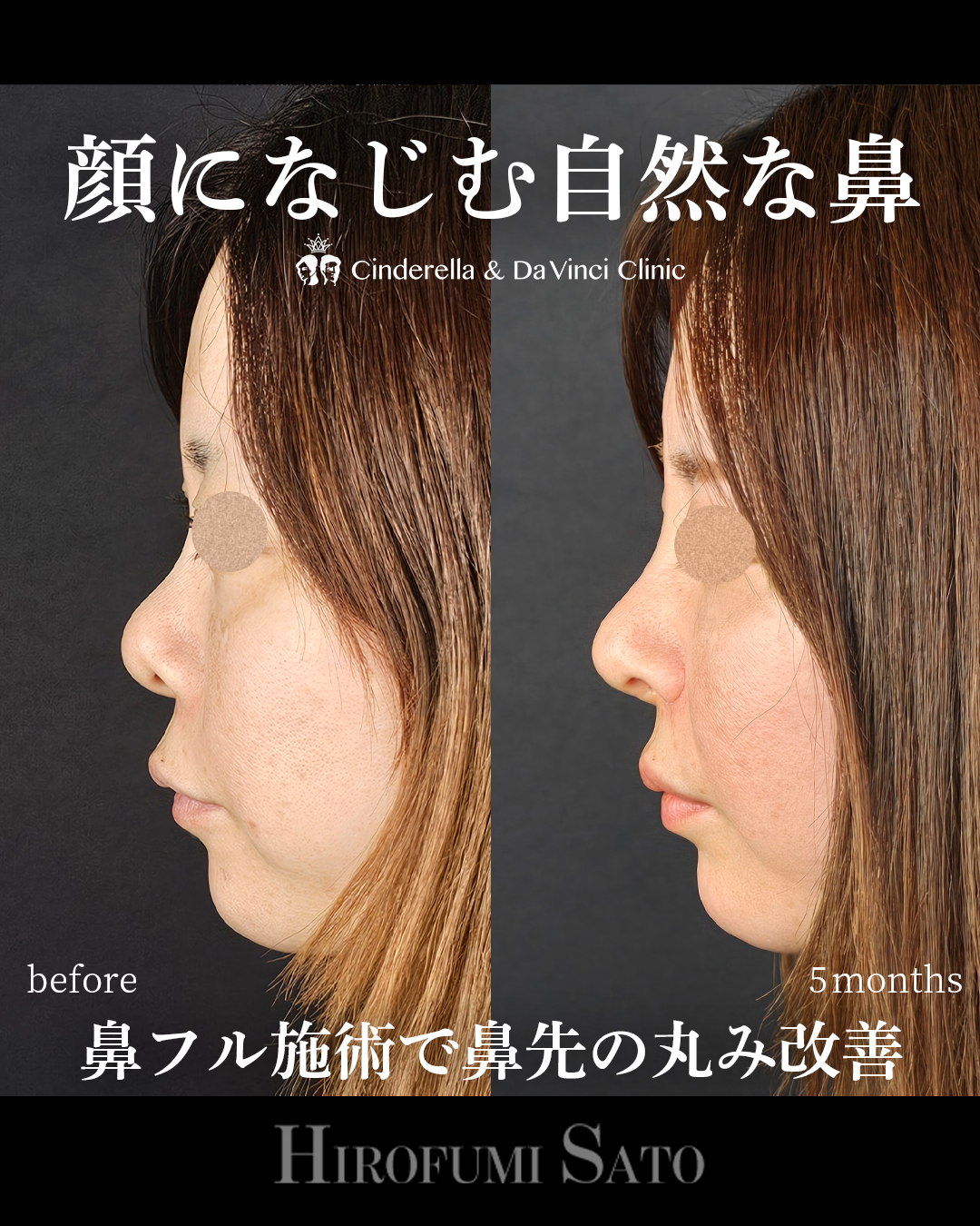 鼻先スッキリの画像