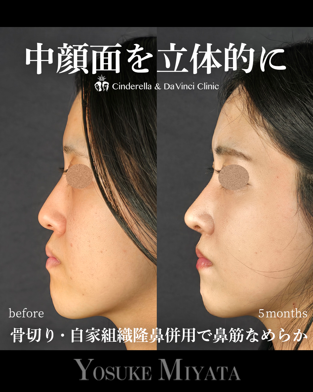 中顔面を立体的にの画像