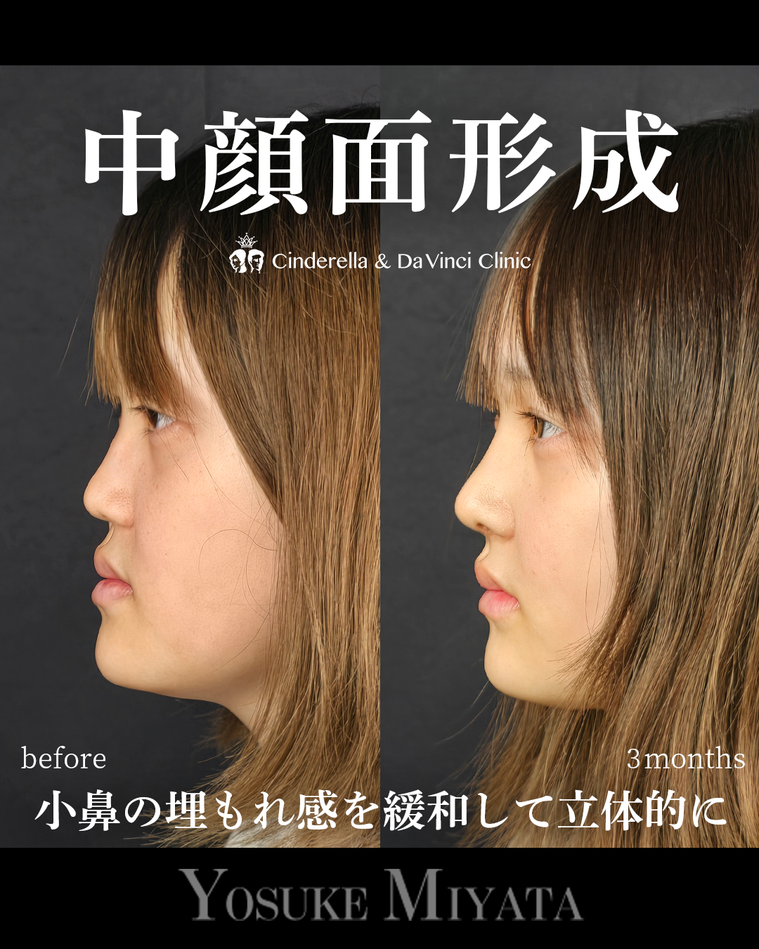 鼻整形で中顔面形成の画像