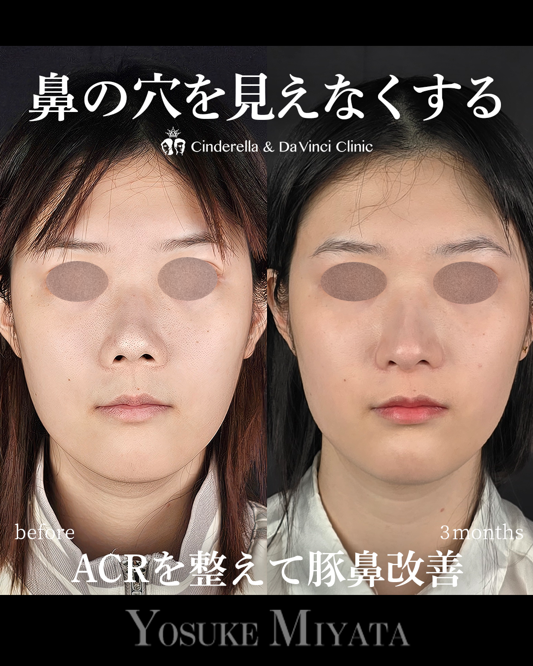 鼻の穴を見えなくするの画像