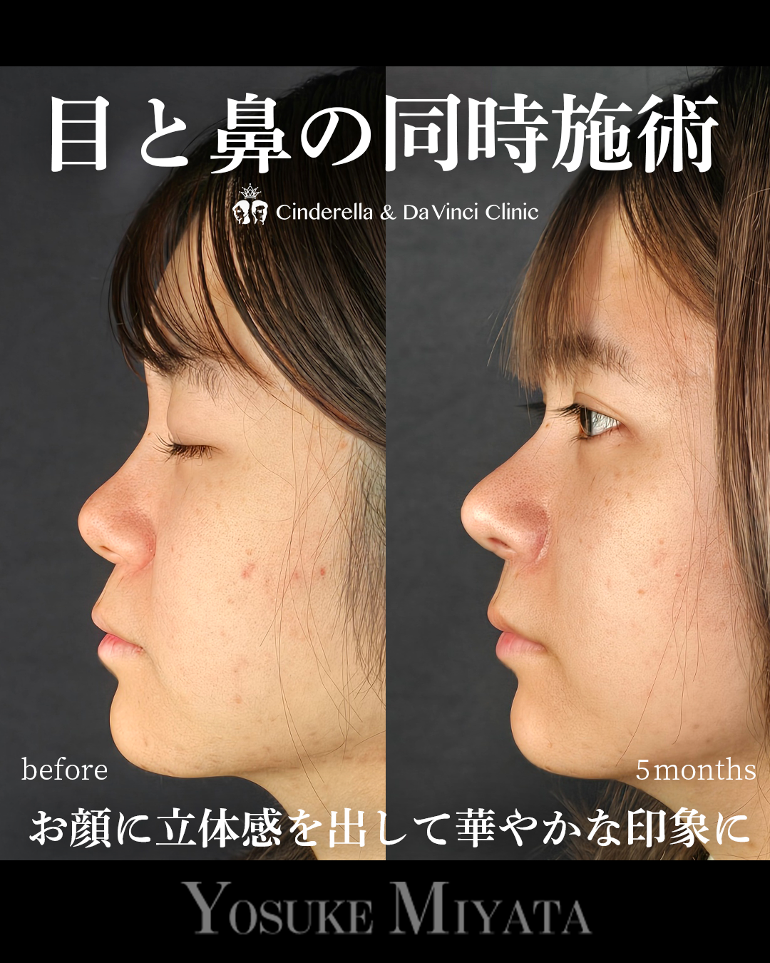 目と鼻の同時施術の画像