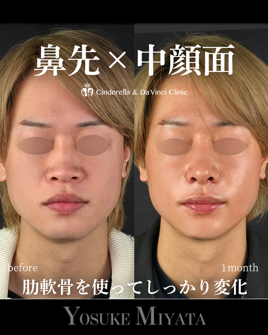 肋軟骨の鼻フルの画像