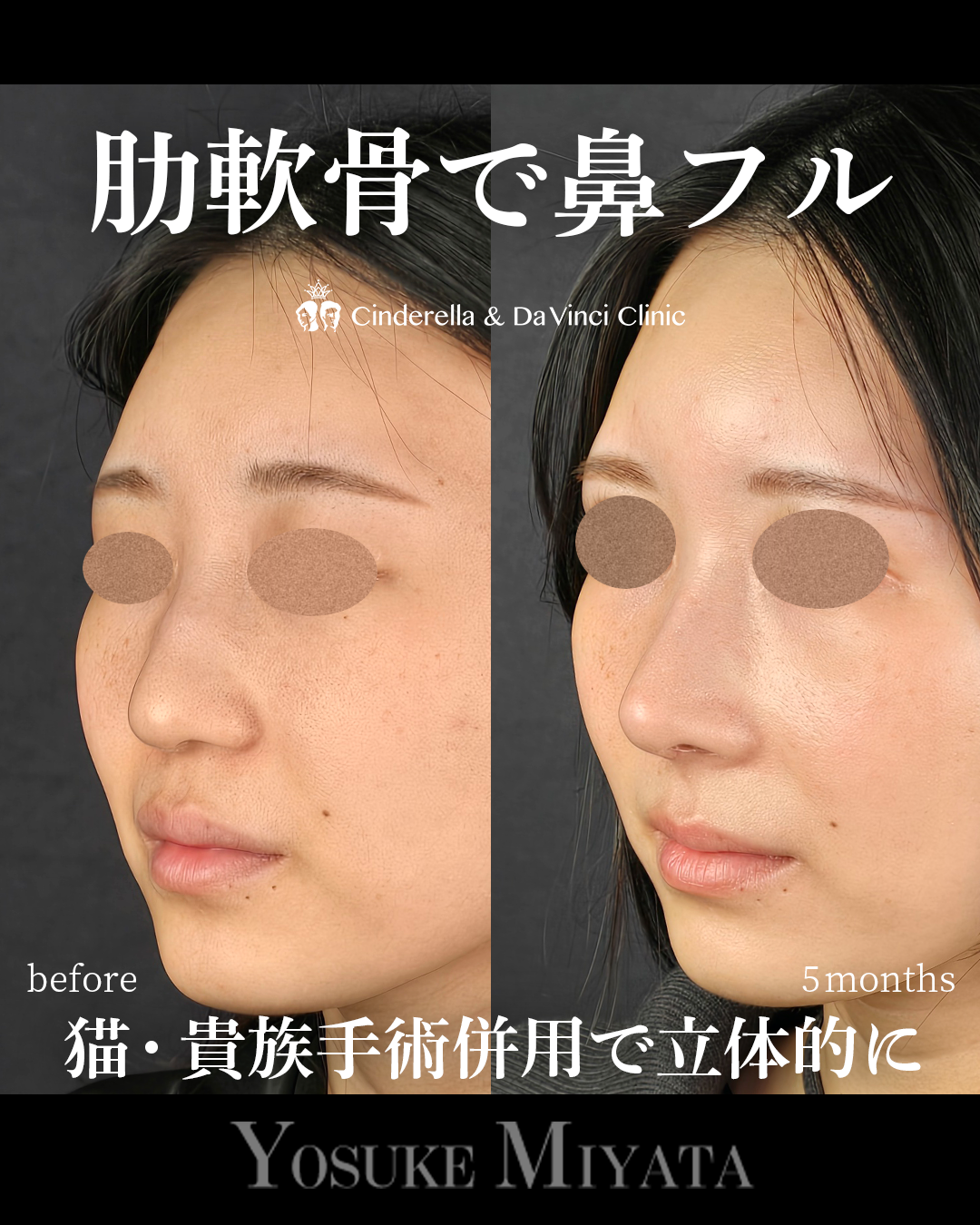 肋軟骨を使った鼻フルの画像