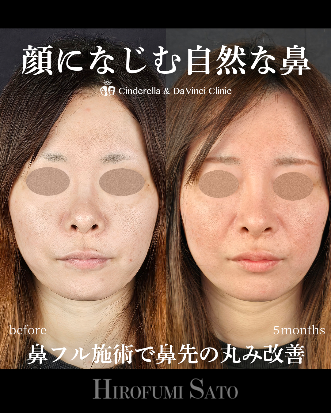 鼻先スッキリの画像