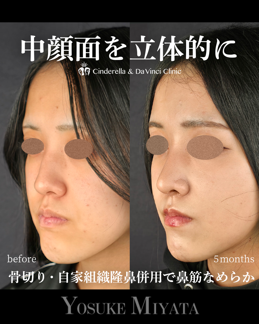 中顔面を立体的にの画像
