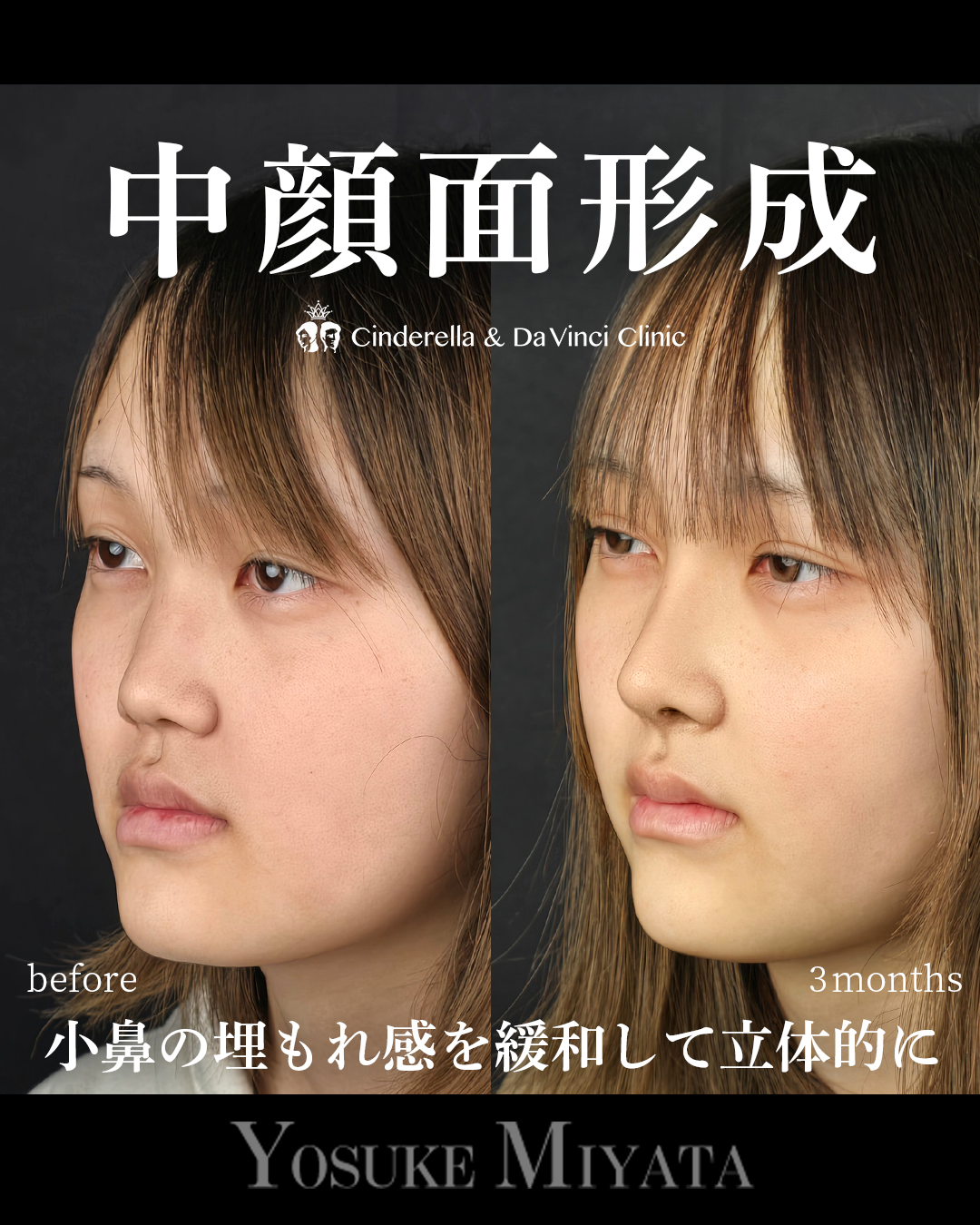 鼻整形で中顔面形成の画像