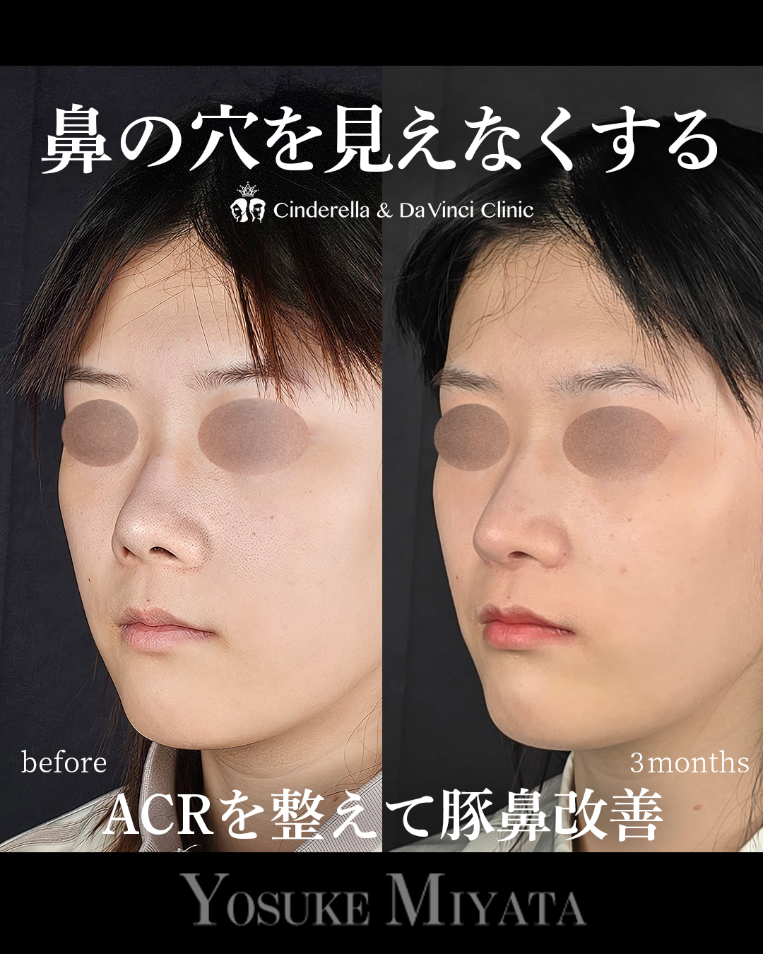 鼻の穴を見えなくするの画像