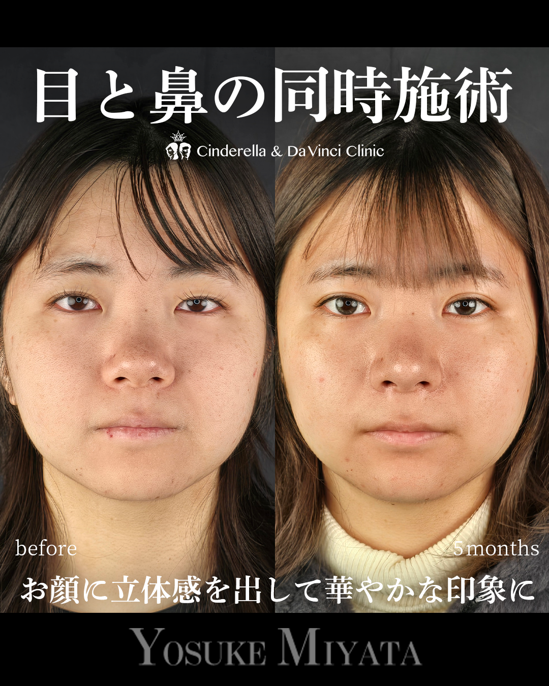 目と鼻の同時施術の画像