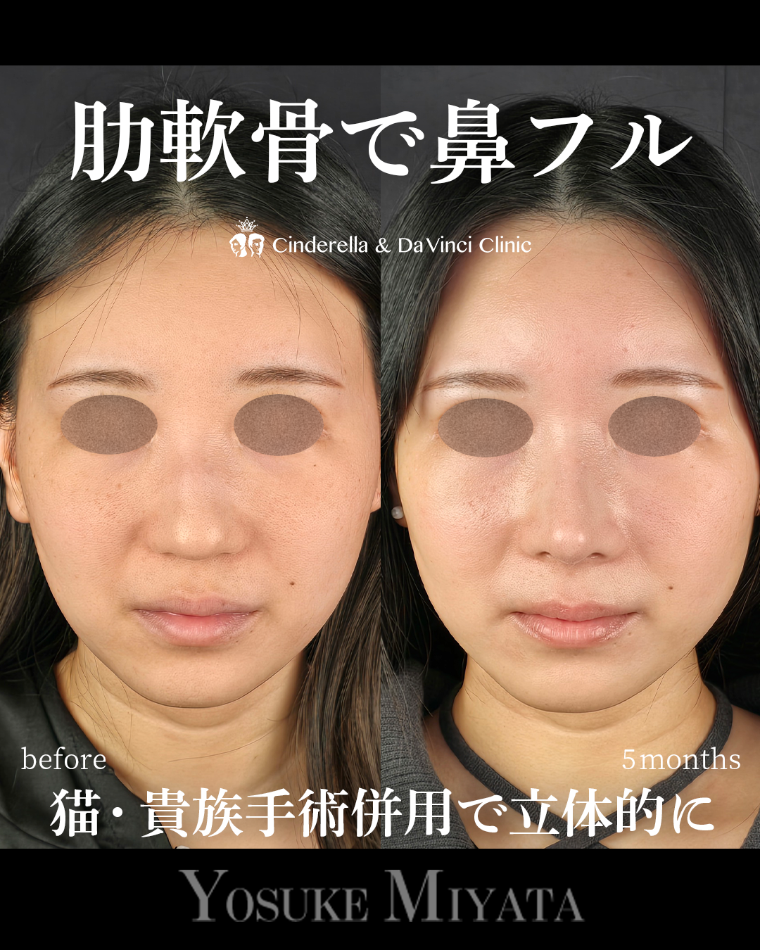 肋軟骨を使った鼻フルの画像