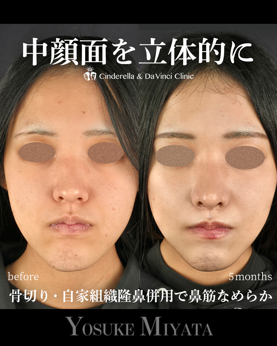 中顔面を立体的にの画像