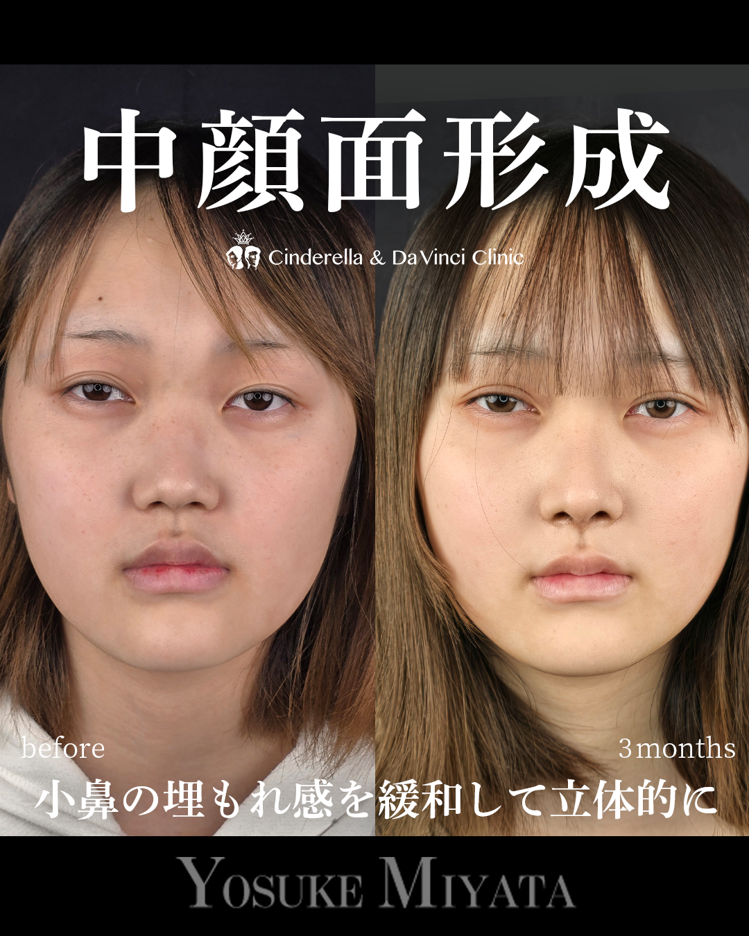 鼻整形で中顔面形成の画像