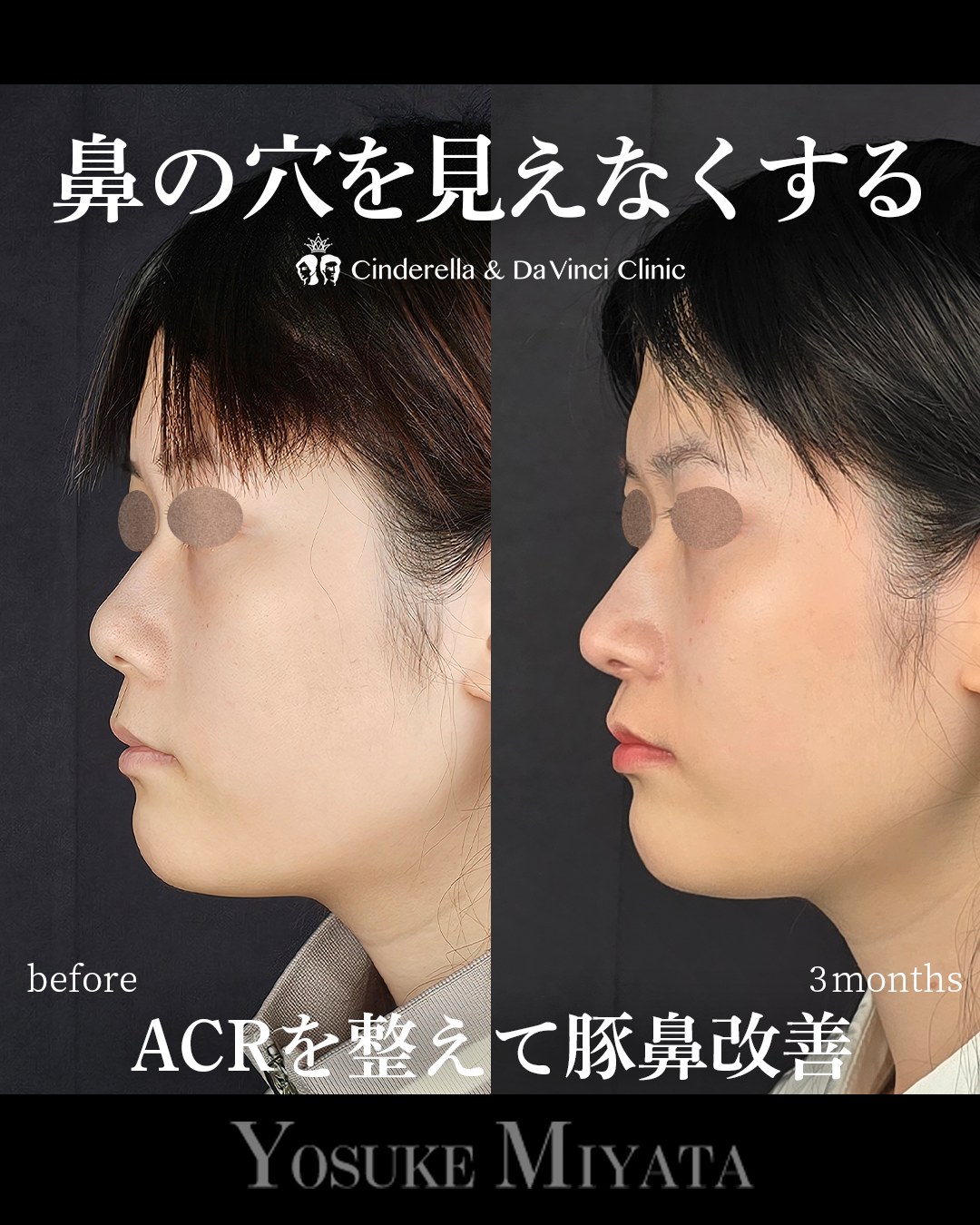 鼻の穴を見えなくするの画像