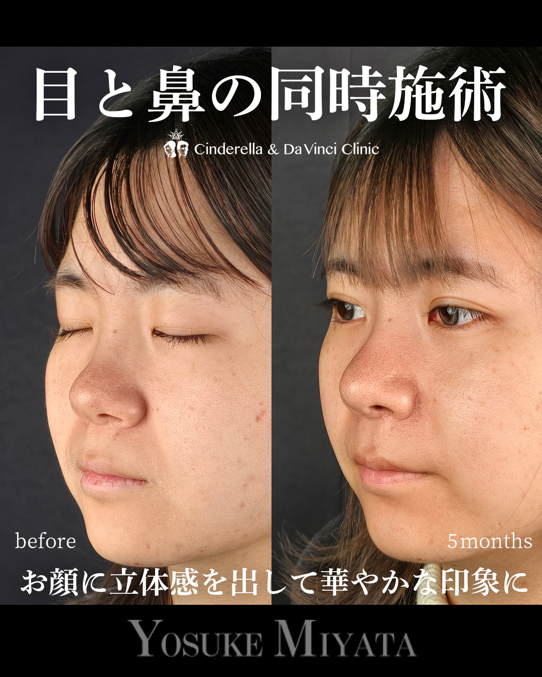 目と鼻の同時施術の画像